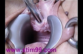 Peehole affectation shacking up urethral seemly interpolate dilatation